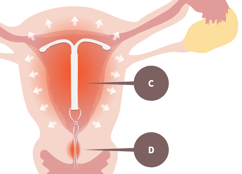 子宮内に装着されたIUS